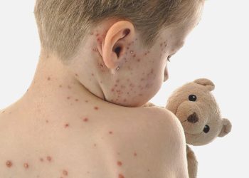 Sıhhat Bakanlığı: Kızamık olayları arttı