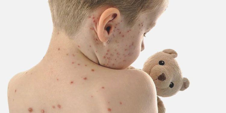 Kızamık hadiseleri korkutan artış