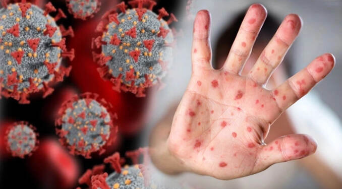 DSÖ’den kritik açıklama: Maymun çiçeği ve Kovid-19 bulaşma farkı…